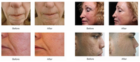 Appareil HIFU Seaheart professionnel pour le lifting du visage et le raffermissement de la peau, destiné aux salons de beauté, cliniques esthétiques et spas