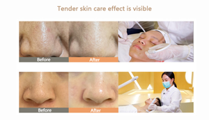 Appareil de soin de la peau multifonction 7 en 1, microdermabrasion, blanchiment, rajeunissement, jet d'oxygène, appareil de soin du visage - Product Image 6