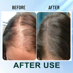 Eelhoe Hair Reborn Scalp Acupoint Massage Apparaat Knoop Verminderen Haargroei Apparaat Hoofdhuid Stimulerende Borstel Haar Behandeling Apparaat - Product Image 6