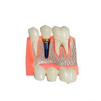 Modèle anatomique dentaire 4x pour la démonstration des implants, la restauration de prothèses, la ponte dentaire détachable, la couronne et l'utilisation pédagogique