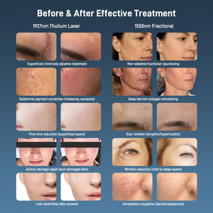 1927 + <span class=keywords><strong>1550nm</strong></span> thulium máy <span class=keywords><strong>laser</strong></span> 1927nm thulium erbium Glass <span class=keywords><strong>1550nm</strong></span> và 1927nm kép thulium <span class=keywords><strong>laser</strong></span> & <span class=keywords><strong>1550nm</strong></span> sợi <span class=keywords><strong>Laser</strong></span> - Product Image 6