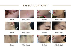 Nuova Macchina Professionale Verticale a CO2 Frazionato 10600nm per Rimozione Pigmenti, Attrezzatura Dermatologica CE OEM - Product Image 6