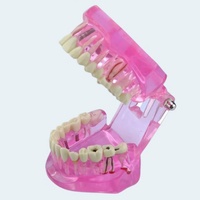 Modèle de pathologies dentaires en plastique, démonstrateur éducatif pour caries, kyste apical, tartre, implant, impaction, etc. FUREIN SMILE