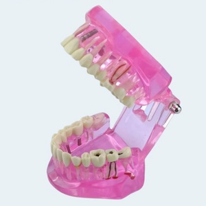 Modèle pédagogique en plastique pour la démonstration des pathologies dentaires : caries, kyste apical, tartre, implant, impaction, etc. - Product Image 3