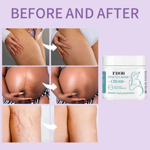 Creme Poderoso para Estrias, Repara Rapidamente Estrias de Gravidez, Estrias Pós-parto e Estrias de Obesidade - Product Image 3