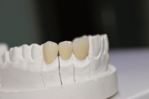 De alta calidad de CAD/CAM personalizado de circonio corona Dental - Product Image 5