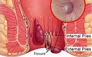 Máquina de Tratamiento de Hemorroides con Láser de Diodo de 980nm para Fístula <span class=keywords><strong>Anal</strong></span> y Hemorroides - Product Image 4