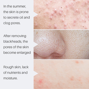 Chiết xuất thảo dược chống nhăn lỏng cho khuôn mặt & đôi môi-Thu nhỏ lỗ chân lông loại bỏ mụn đầu đen & mụn trứng cá đánh dấu 30ml - Product Image 3