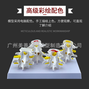 Quatre équipes de modèles pathologiques de la colonne vertébrale lombaire, quatre paires de modèles de lésions des disques lombaires, modèles de pathologie des disques intervertébraux - Product Image 5