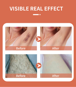 Precio de Fábrica, Depiladora <span class=keywords><strong>Láser</strong></span> de Diodo 808nm, Máquina de Depilación 808nm, Cepillo de <span class=keywords><strong>Limpieza</strong></span> - Product Image 5