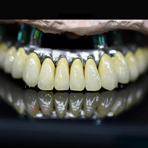Implantes personalizados Solución de reemplazo dental Implantes dentales con el cuidado adecuado - Product Image 5