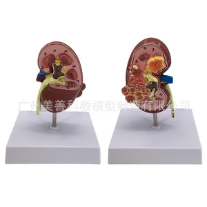 Modelo anatómico de riñón humano, modelo de riñón patológico, especialidad de urología y andrología. - Product Image 1