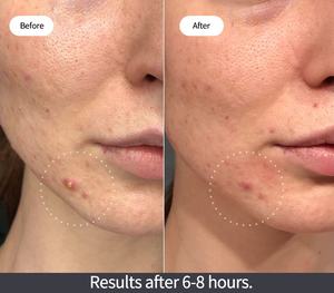 Parche curativo de emergencia para árbol de té, granos de acné, de Corea, Oem - Product Image 4