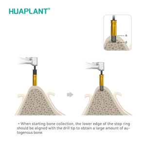 Huaplant Aanpasbare Tandheelkundige Implantaat Boor Gereedschapskit Oem Odm Autogene Bot Oogsten Boor Handleiding Metalen Tandarts Apparatuur - Product Image 4
