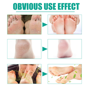 <span class=keywords><strong>Desodorante</strong></span> <span class=keywords><strong>para</strong></span> el cuidado de los <span class=keywords><strong>pies</strong></span> OUHOE, spray <span class=keywords><strong>para</strong></span> aliviar la picazón, spray <span class=keywords><strong>para</strong></span> el olor de los <span class=keywords><strong>pies</strong></span>, blister, peeling, tratamiento <span class=keywords><strong>para</strong></span> <span class=keywords><strong>pies</strong></span> podridos, spray antimicótico <span class=keywords><strong>para</strong></span> <span class=keywords><strong>pies</strong></span> - Product Image 5