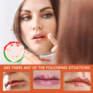 ครีมสมุนไพรซูมิฟุน ไฮโดรคอลลอยด์ สำหรับรักษาแผล<span class=keywords><strong>เป็น</strong></span>จากไข้หวัดเย็นบริเวณริมฝีปาก - Product Image 4