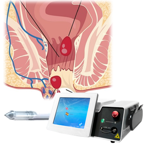 Láser Hemorroides Cirugía de fístula anal 1470nm 980nm Fibra cónica Pilas Corte Fisure Diodo Dual Láser Médico CE U.S Proctología - Product Image 1