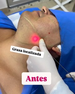 Facelift Abdominal Fat Lipólisis Endolaser 980nm 1470nm Dispositivo láser para uso de cirujano estético - Product Image 6