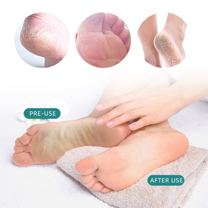 Strumenti professionali <span class=keywords><strong>per</strong></span> Pedicure <span class=keywords><strong>per</strong></span> pelle morta - Product Image 6
