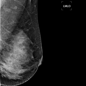 Y tế kỹ thuật số mammography x Ray thiết bị 5KW xách tay kỹ thuật số DR mammography giá máy - Product Image 5