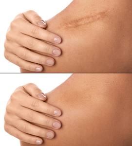 Bande de retrait de <span class=keywords><strong>cicatrice</strong></span> en <span class=keywords><strong>silicone</strong></span> de qualité médicale Rouleau de <span class=keywords><strong>gel</strong></span> de <span class=keywords><strong>cicatrice</strong></span> en <span class=keywords><strong>silicone</strong></span> souple - Product Image 5