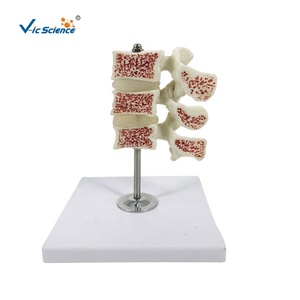 <span class=keywords><strong>Modello</strong></span> Anatomico Deluxe dell'Osteoporosi Umana PreNext con Icone Simili e Sezioni Trasversali - Product Image 1