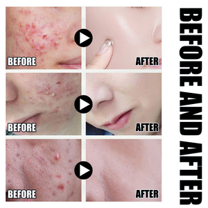 Thương Hiệu Tư Nhân Chống Mụn Trứng Cá Loại Bỏ Mụn Trứng Cá Loại Bỏ Vết Sẹo Mặt Huyết Thanh Kiểm Soát Mụn Trứng Cá Loại Bỏ Tốt Nhất Huyết Thanh Cho Mụn Salicylic Axit Huyết Thanh - Product Image 4