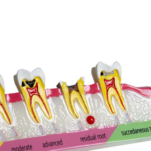 Modelo de Clasificación de Caries Dentales, Demostración de la Evolución de la Caries, Explicación de la Comunicación Médico-Paciente, Enseñanza Dental - Product Image 1