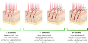 Casco per Trattamento Calvizie Uomo Donna, Casco per Ricrescita Capelli Terapia Luce Rossa 650nm Laser LLLT - Product Image 4