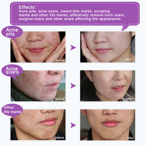 Patch en silicone ELAIMEI pour cicatrices, soin avancé, cicatrisation rapide, réparation de la peau, hydratant, bande de couverture en silicone - Product Image 5