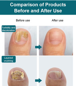 Traitement Liquide Extra Fort Contre la <span class=keywords><strong>Mycose</strong></span> des Ongles 25% Acide Undécylénique, Soin <span class=keywords><strong>Antifongique</strong></span> pour Ongles des Pieds et des Mains à l'Huile d'Arbre à Thé pour la Peau des Pieds - Product Image 4