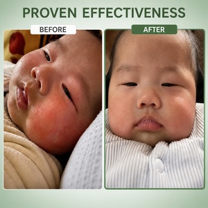 YIHE-HEALTH eczema <span class=keywords><strong>crema</strong></span> alle erbe - Product Image 2