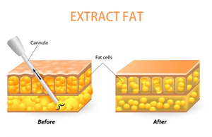 Neuestes Professionelles Optisches Faser-Endolaser-Gerät zur Hautstraffung und Gesichtslipolyse 1470nm Liposuktion-Lasergerät - Product Image 5
