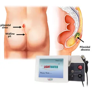 Láser <span class=keywords><strong>Hemorroides</strong></span> clase IV onda dual 1470nm 980nm proctología anal fístula anoscopios proctoscopios instrumento de terapia médica - Product Image 1