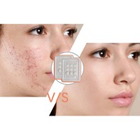 Patchs hydrocolloïdes pour l'acné, patchs pour boutons, patchs pour les boutons du visage, patchs pour les boutons et les éruptions cutanées