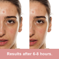 Patchs Points Anti-Acné Coréens à l'Acide Salicylique Hydrocolloïde pour Boutons Faciaux