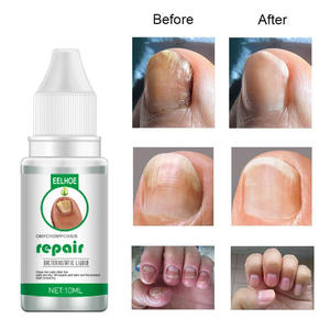 2025 Tik Tok Venta caliente Herbal Nail Foot Toe Nail Fungus Tratamiento Reparación de uñas Líquido Cuidado de los pies - Product Image 2