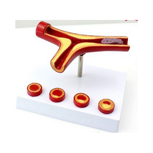 Modelo de Arteriosclerosis con Trombosis, Modelo Anatómico para Ciencias Médicas BIX-A725 (China) - Product Image 1