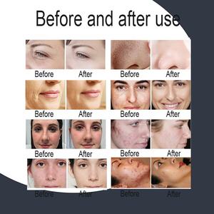 เครื่องกำจัดสิวไฮโดรสกินขนาด7อิน1เครื่องกำจัดสิวใต้น้ำลอกผิวด้วยฟองขนาดเล็ก - Product Image 6