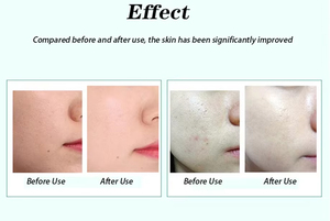 2025 New Diamond Micro-carving Oxygen Injection Instrument Skin Rejuvenation Removes Skin Stubbon Impurities Anti-aging Machine - Product Image 6