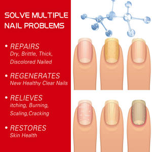 Soins des pieds ongles pied blanchiment orteil élimination des champignons sérum Gel Anti Infection Paronychia onychomycose traitement fongique - Product Image 4