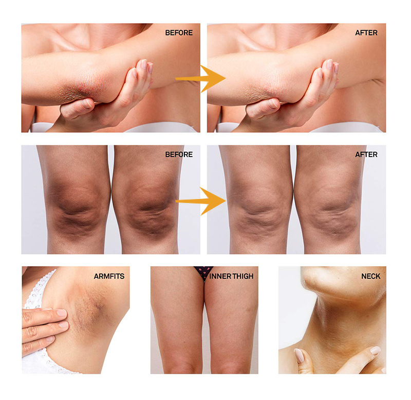 Body Underarm Whitening Cream Armpit Leg Knee Private Parts Brightening Melanin Remover Black Skin Whitening Cream