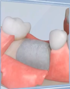 GBR <span class=keywords><strong>Dental</strong></span> membrana Bio impianti dentali Membranel protesi dentarie innesto - Product Image 6