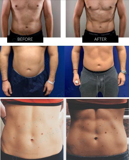 High Intensity 150Hz Ems Fat Burning Machine Sgs Approved