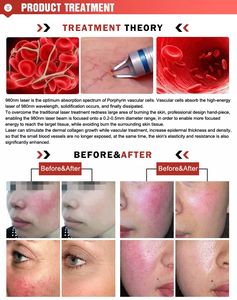 Eliminación vascular láser y <span class=keywords><strong>tratamiento</strong></span> de <span class=keywords><strong>hongos</strong></span> en las <span class=keywords><strong>uñas</strong></span> Máquina láser de diodo de 980nm Máquina de eliminación de arañas vasculares - Product Image 5