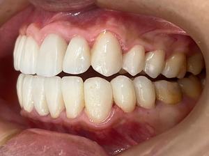 Blocco di Zirconia per Protesi Dentali CAD/CAM - Product Image 4