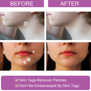ELAIMEI Pain Scar Free <strong>Skin</strong> <strong>Tag</strong> <strong>Remove</strong> Mole Acne Wart <strong>Remover</strong> <strong>Patch</strong> - Product Image 5