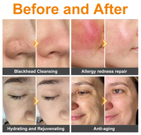 Machine de soin du visage par hydro-microdermabrasion, machine de spa pour le soin du visage, jet d'oxygène, bulles d'eau, machine de nettoyage de la peau du visage H2O2