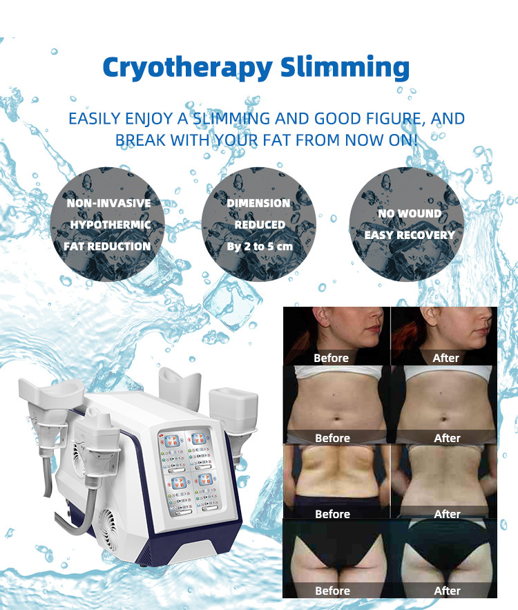 HOT Sales Cryotherapy machine 360 cooling technology Non-invasive fat reduction any treatment area at any angle
