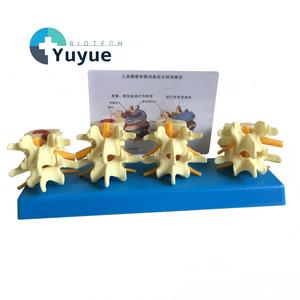 แบบจำลองโรคหมอนรอง<span class=keywords><strong>กระดูก</strong></span>สันหลังส่วนเอวของมนุษย์ 4 ขั้นตอน พร้อมการเปรียบเทียบโรค<span class=keywords><strong>กระดูก</strong></span>พรุน สำหรับการสอนด้านศัลยกรรม<span class=keywords><strong>กระดูก</strong></span> - Product Image 1